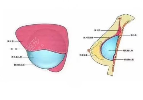 胸型不好看可以調(diào)整嗎？