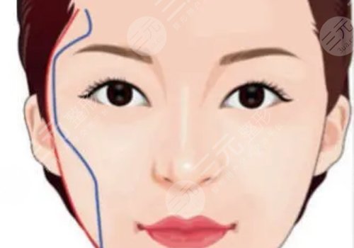 顴弓吸脂有什么后遺癥？