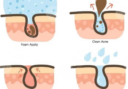 t區(qū)出油毛孔粗大怎么辦？