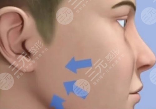 外輪廓固定提升有哪些手術(shù)方案？