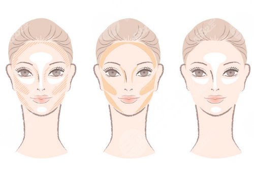 外輪廓固定提升有哪些手術(shù)方案？