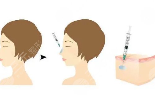 外輪廓提升需要幾支玻尿酸？