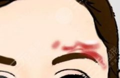 祛疤痕好的方法目前有效的3種醫(yī)美介紹！美膚修復(fù)指南~