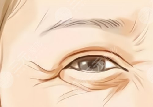 薇旖美可以注射眼部周圍的皺紋不？