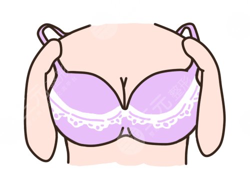 自體隆胸可以保持幾年？