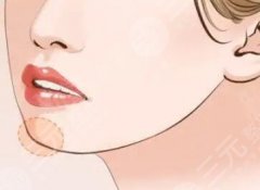 下巴整形如何選擇下巴假體？墊下巴術(shù)前必看指南！
