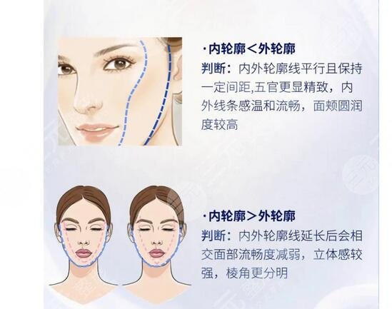 臉部輪廓固定能維持多久？