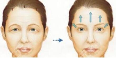面部提拉緊致手術(shù)護理注意事項