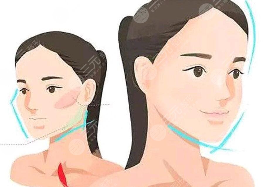 面部輪廓整形