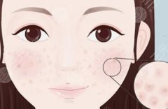 有什么微整形緩解毛孔粗大？3種輕醫(yī)美幫你搞定，科普介紹！