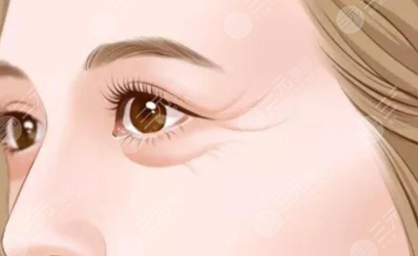 眼部拉皮手術(shù)