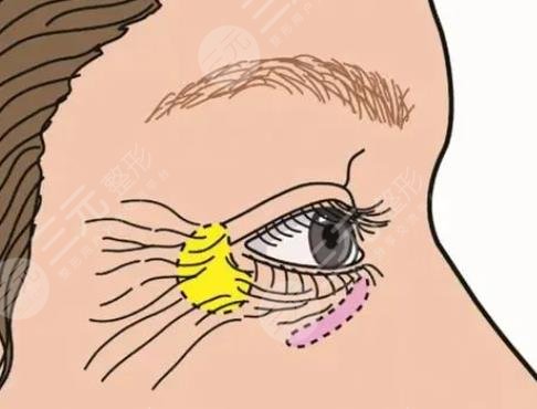 眼部拉皮手術(shù)