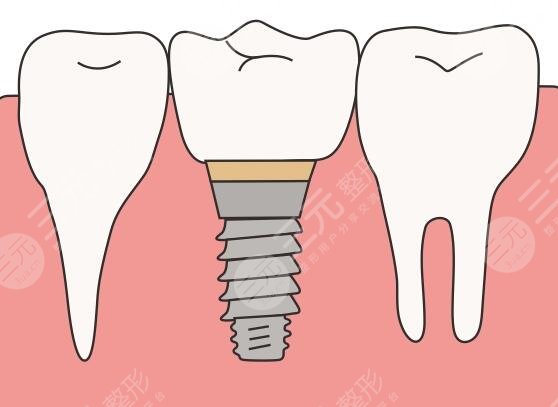 上海新華醫(yī)院種植牙齒案例