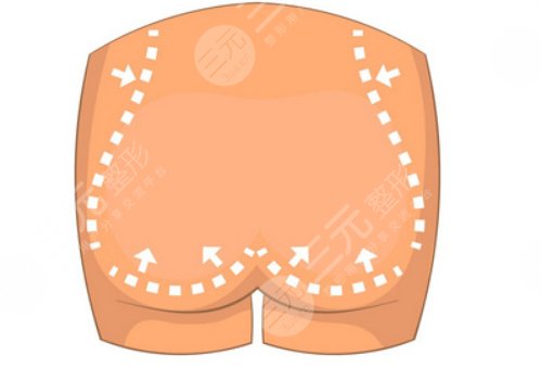 媽媽臀吸脂多久可以恢復？