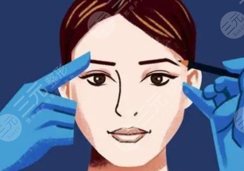 吳秀英雙眼皮案例