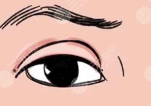 雙眼皮肉條感怎么樣可以消失？