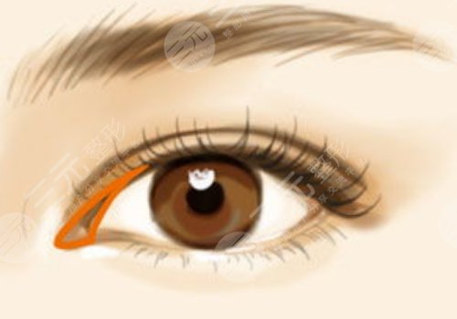 雙眼皮肉條感怎么樣可以消失？