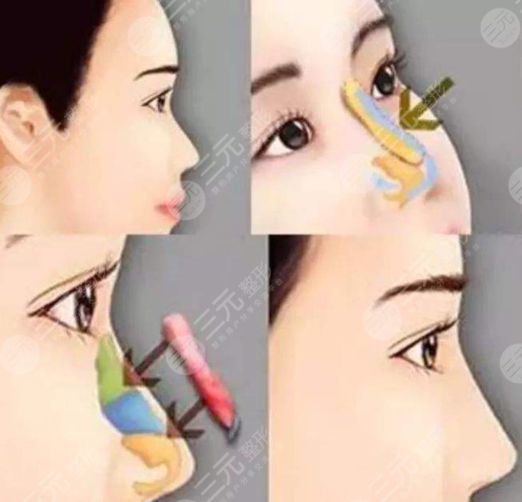 上海第六人民醫(yī)院整形科隆鼻案例