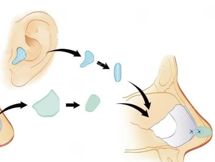 北京韓興斌醫(yī)生擅長項(xiàng)目科普