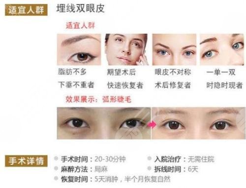 雙眼皮分為哪幾種做法？