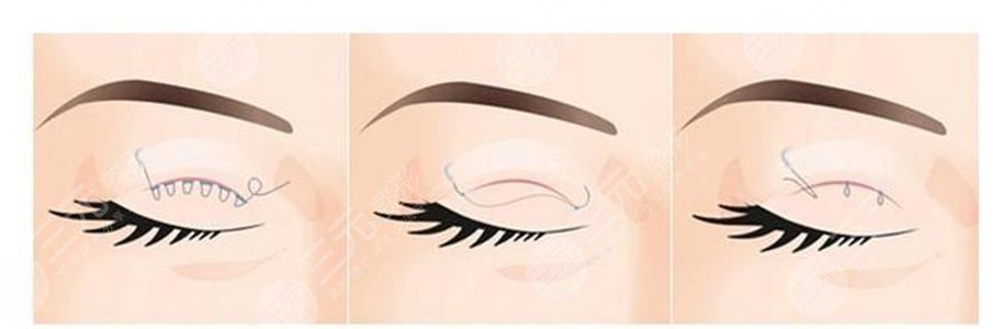 雙眼皮分為哪幾種做法？