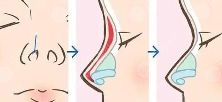 上海仁濟醫(yī)院整形科隆鼻案例