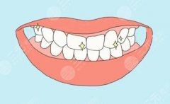 牙齒整形做義齒修復(fù)好嗎？牙齒缺失這樣做！價(jià)格費(fèi)用查詢~