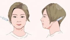 改良下巴有哪些整形項目？這3種可以做，重塑美學輪廓！