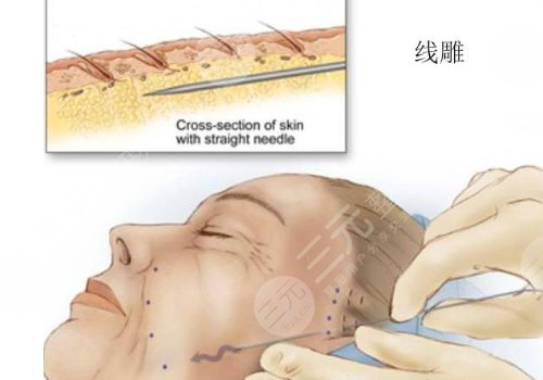 韓國美迪塑線雕怎么樣