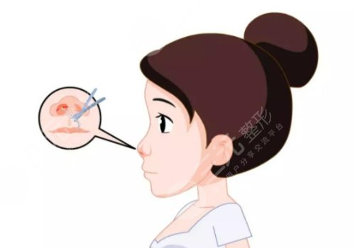 國(guó)產(chǎn)立秀膨體隆鼻好嗎