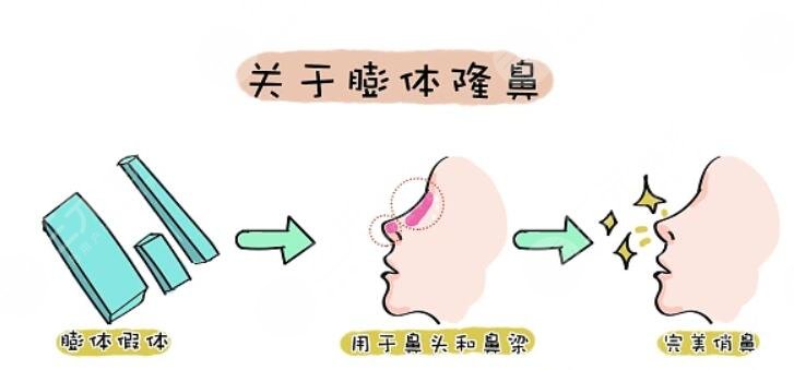 隆鼻維持的時間