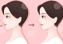 凸嘴整形手術(shù)前后對(duì)比圖解！骨性or牙性？術(shù)前必看科普~
