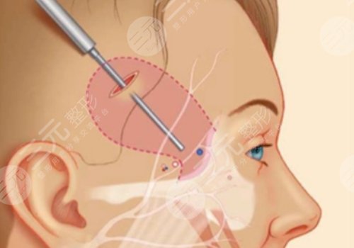 微拉美的危害和副作用都有哪些？