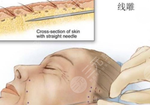 韓國美迪塑線雕能維持幾年