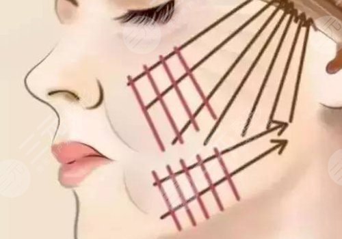 韓國美迪塑線雕能維持幾年