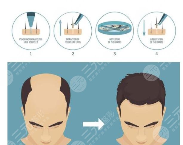 東莞人民醫(yī)院植發(fā)案例分享