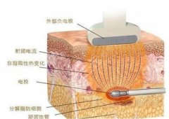黃金微針多久可以化妝？美膚抗衰性價比之選，術(shù)前術(shù)后常識科普！