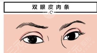 雙眼皮修復(fù)