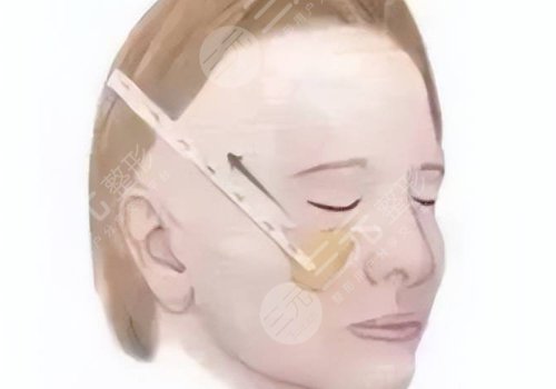 微拉美是什么整容項目