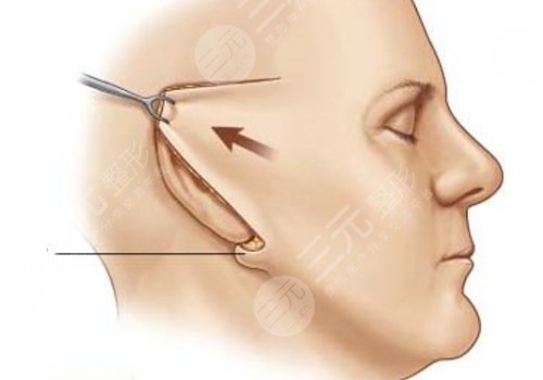 威海拉皮美容要多少錢