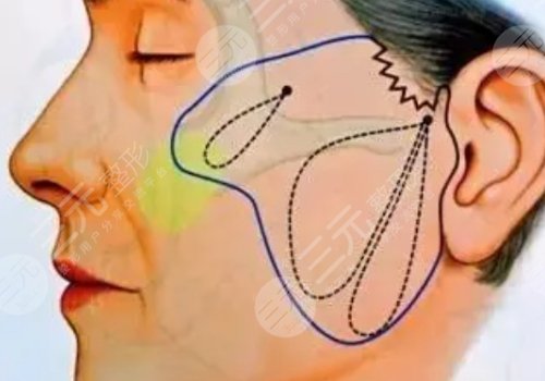 威海拉皮美容要多少錢