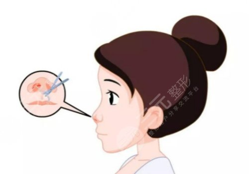 王晉煌做鼻子怎么樣