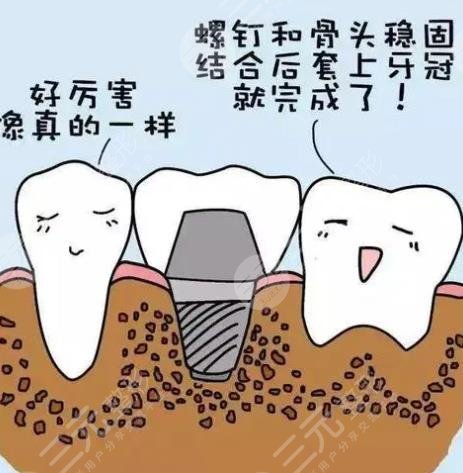 上海長(zhǎng)海醫(yī)院口腔科牙齒種植案例