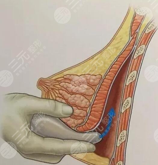 英捷爾法勒隆胸注意事項