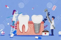 德國(guó)種牙種植體哪個(gè)品牌好？匯總3款常用材料，術(shù)前必看！