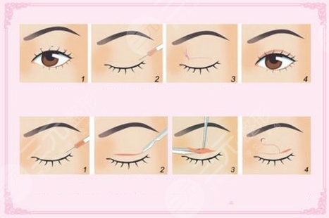 閆家峰做雙眼皮怎么樣？熱門醫(yī)生簡(jiǎn)介，案例反饋為你揭曉！