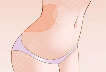 剖腹產(chǎn)疤痕修復