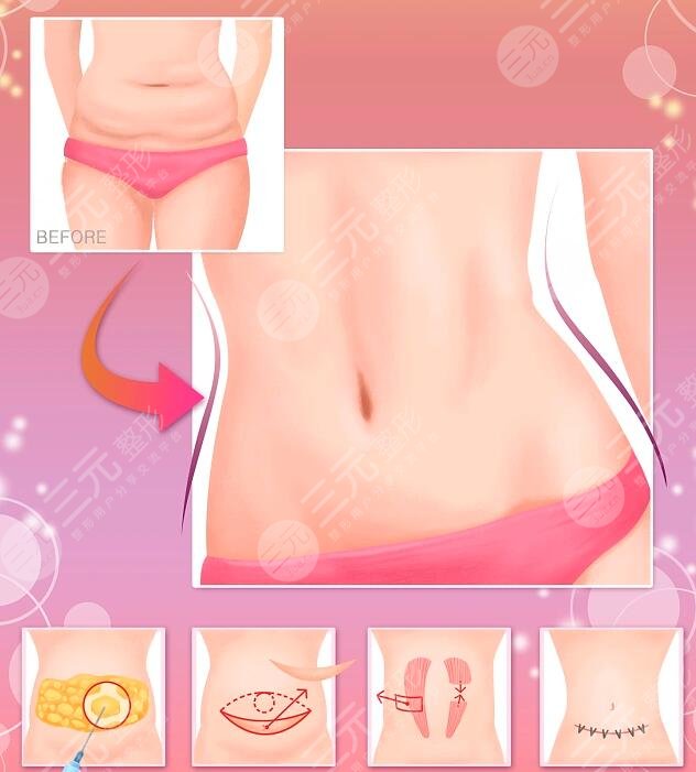 全身抽脂可以保持多久？