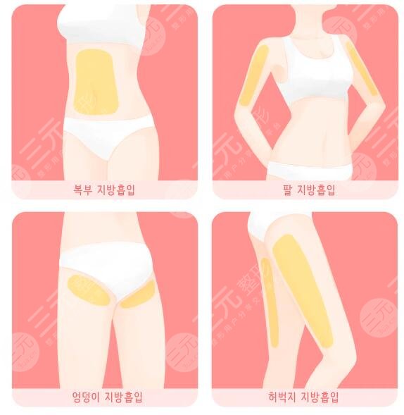 全身抽脂可以保持多久？