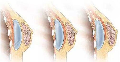 假體隆胸術(shù)后可以哺乳嗎?